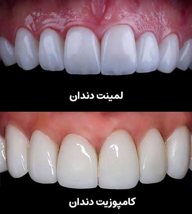 فرق لمینت و کامپوزیت عکس
