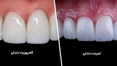 فرق لمینت و کامپوزیت دندان