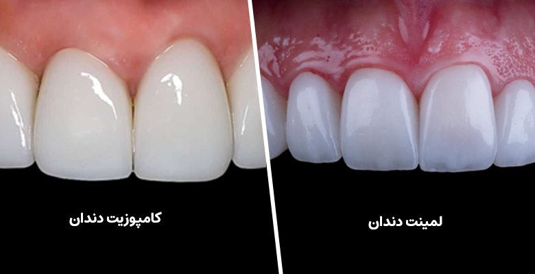فرق لمینت و کامپوزیت دندان